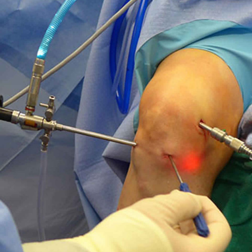 arthroscopy in Warangal 