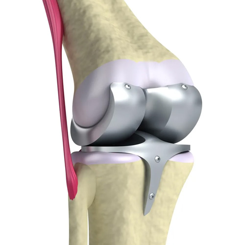 knee replacement in warangal