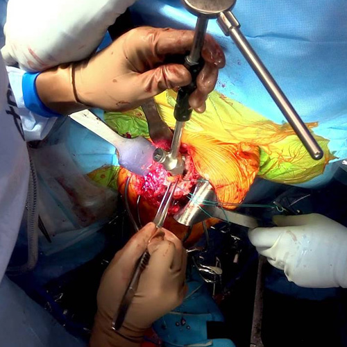 shoulder replacement surgery in Warangal